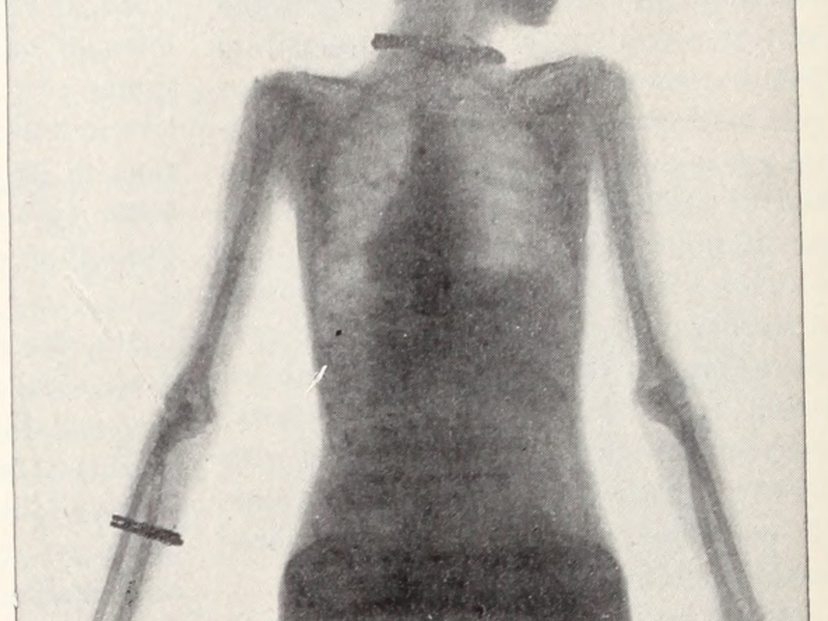 Early X-ray - World History Encyclopedia