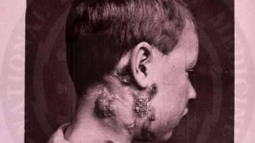 Scrofula on the Neck of a Boy