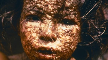 Child with Smallpox, Bangladesh