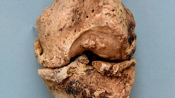 Arthritis of a Knee Joint of a Mummy