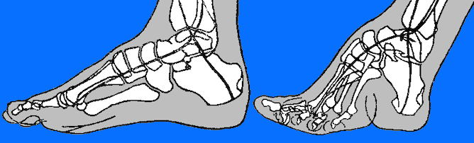 The Effects of Foot-binding on the Foot Bones