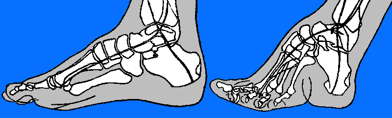 The Effects of Foot-binding on the Foot Bones