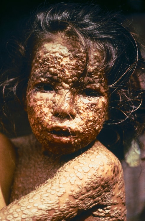 Child with Smallpox, Bangladesh