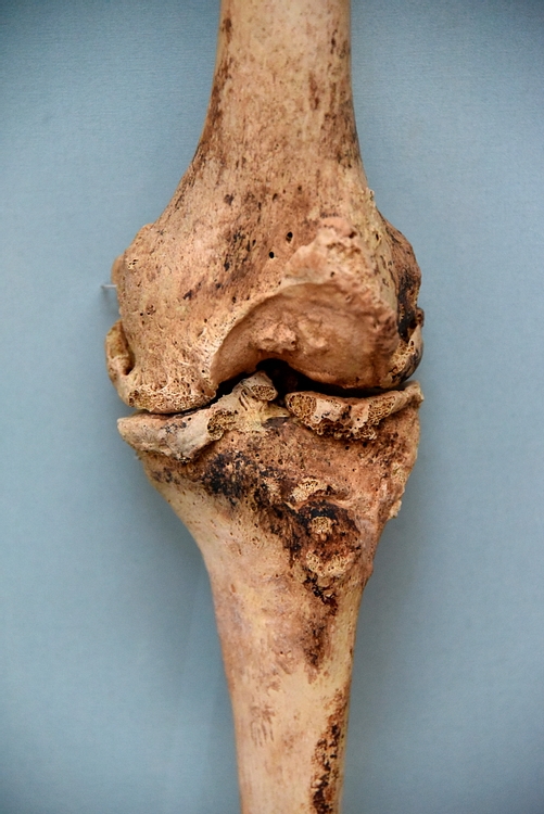 Arthritis of a Knee Joint of a Mummy