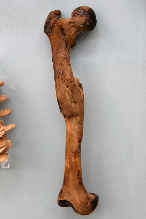 Fractured Femur of an Egyptian Mummy